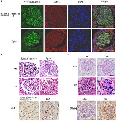 SUMO1 Promotes Mesangial Cell Proliferation Through Inhibiting Autophagy in a Cell Model of IgA Nephropathy